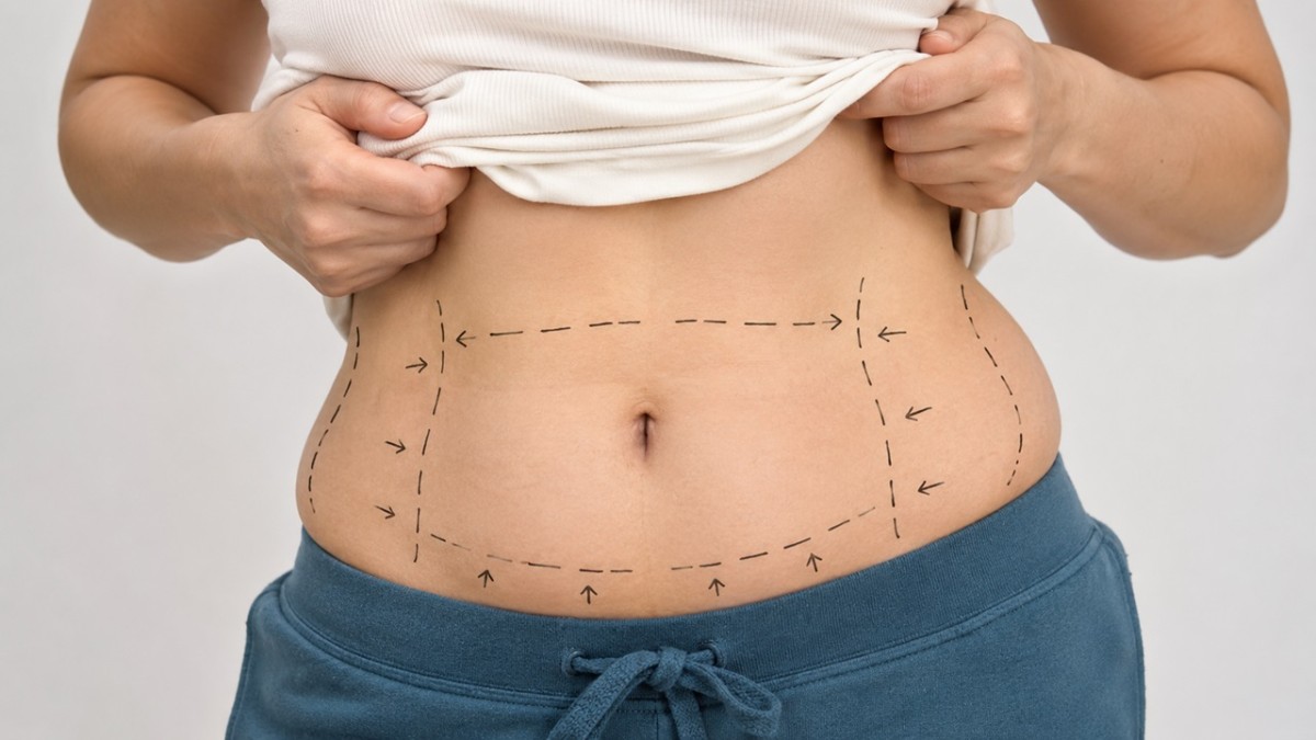 Kalıcı Vücut Hattı Arayışı: Liposuction Sürecinin Tüm Aşamaları